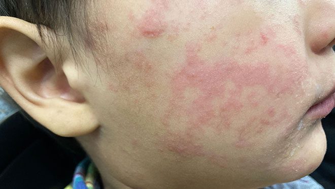 Measles rash