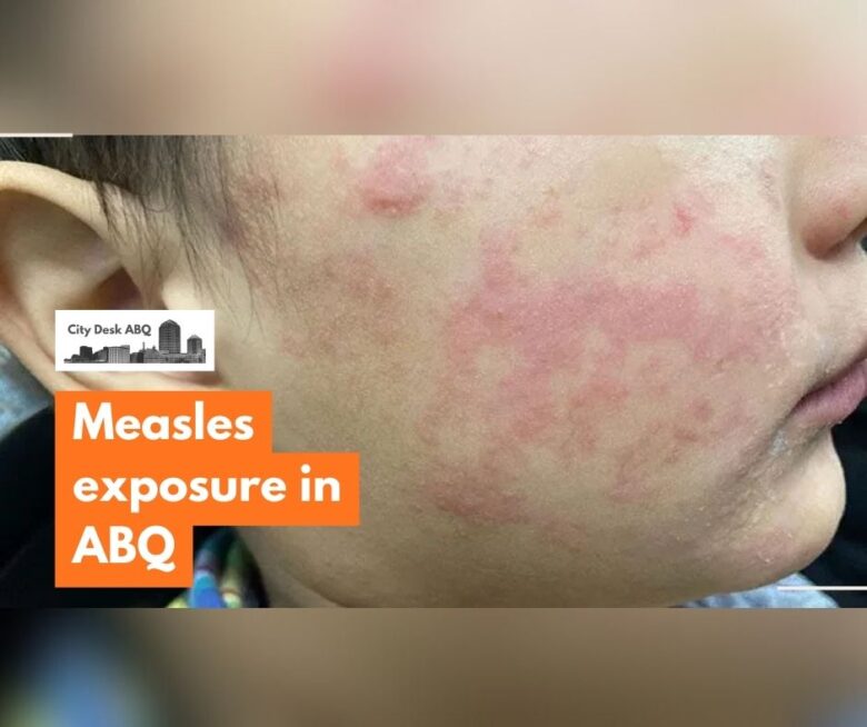 Health officials are warning of possible measles exposure after a traveler diagnosed with the disease spent several hours at an Albuquerque hotel late last month.