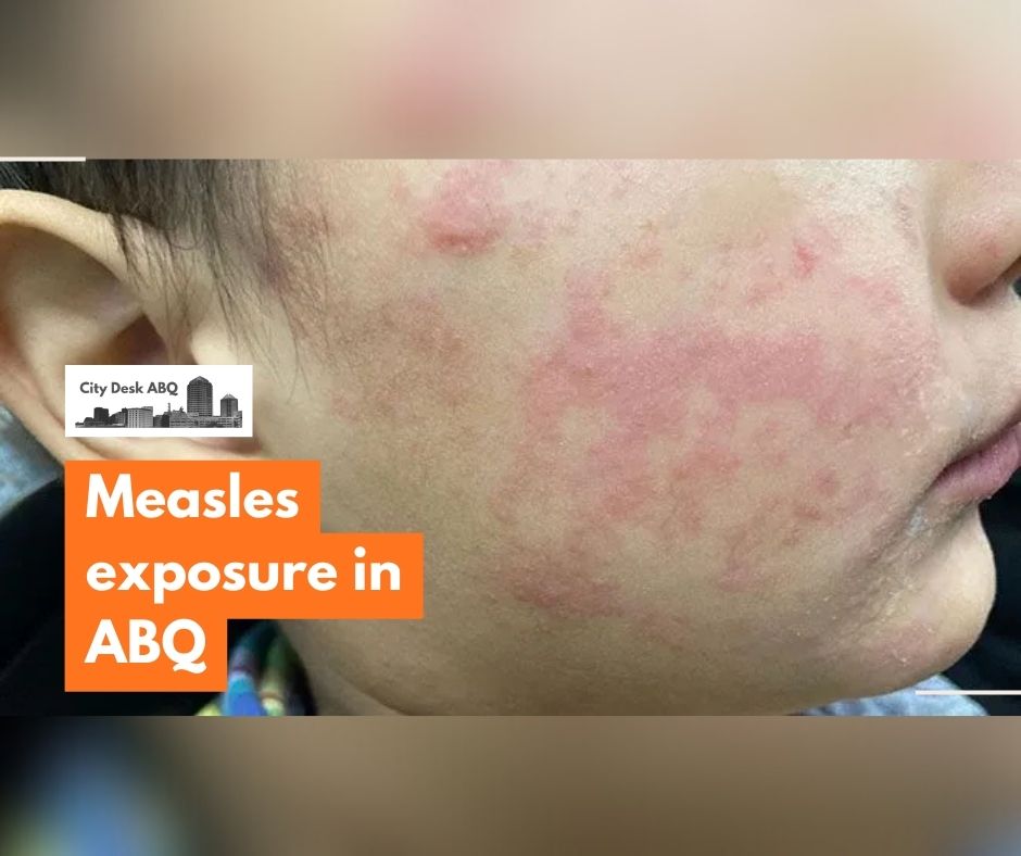 Health officials are warning of possible measles exposure after a traveler diagnosed with the disease spent several hours at an Albuquerque hotel late last month.
